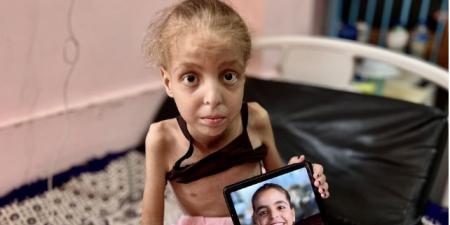 خست 16 كيلو.. طفلة فلسطينية تحول جسدها لهيكل عظمى ووالدتها تناشد بسرعة علاجها - هرم مصر
