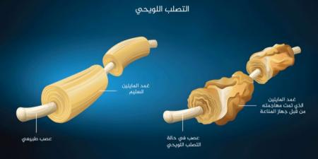الكوابح البروتينية مفتاح لحل معضلة التصلب المتعدد - هرم مصر