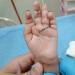 جامعة الزقازيق: نجاح زراعة أصابع رضيع مبتورة واستعادة وظيفتها بصورة كاملة| شاهد - هرم مصر