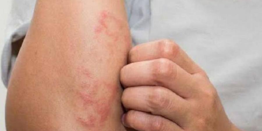أبرز الأمراض الجلدية المرتبطة بفصل الصيف - هرم مصر