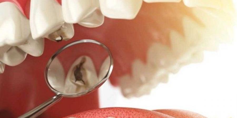 حارب تسوس الأسنان بتناول هذا الفيتامين.. نتائجه مذهلة| تفاصيل - هرم مصر