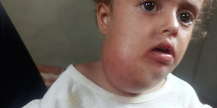 ورم في رقبتها وصعوبة بالنطق.. عجز المنظومة الصحية بغزة يهدد حياة الطفلة جوليا - هرم مصر