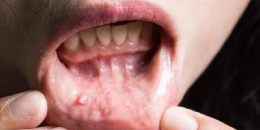 هل تسبب حقن التنحيف مشاكل صحية للفم؟ - هرم مصر