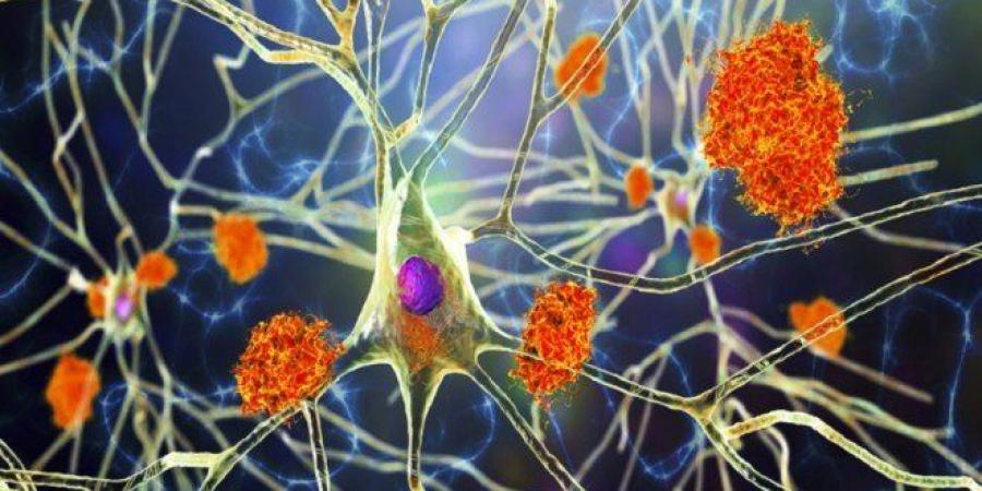 دراسة تكشف مؤشراً مبكراً قد يساعد في إبطاء مرض ألزهايمر.. ما تفاصيلها؟ - هرم مصر